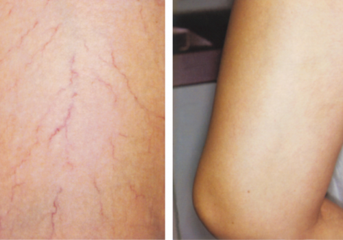 laser skin resurfacing3