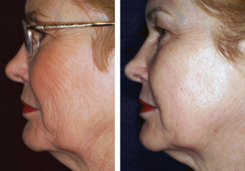 laser skin resurfacing4