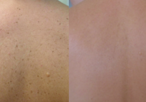 laser skin resurfacing5